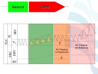 Abbildung 21: COPD - Osteoporose