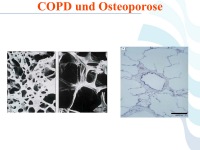 Abbildung 51: COPD - Osteoporose