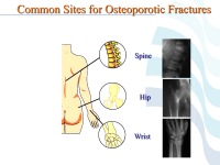 Abbildung 56: COPD - Osteoporose