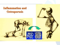 Abbildung 76: COPD - Osteoporose
