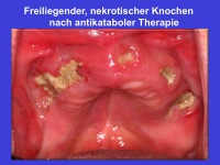 Abbildung 13: Parenterale Bisphosphonate