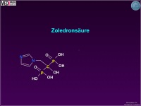 Abbildung 20: Osteoporose