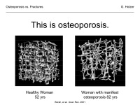 Abbildung 2: Osteoporose - Frakturen
