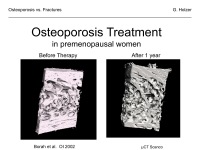Abbildung 8: Osteoporose - Frakturen