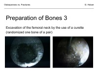 Abbildung 22: Osteoporose - Frakturen