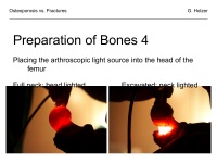 Abbildung 23: Osteoporose - Frakturen