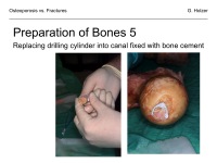 Abbildung 24: Osteoporose - Frakturen