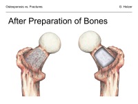 Abbildung 25: Osteoporose - Frakturen