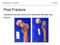 Abbildung 31: Osteoporose - Frakturen