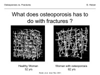 Abbildung 44: Osteoporose - Frakturen