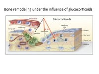 Abbildung 17: Osteoporose