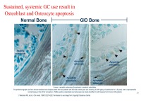 Abbildung 19: Osteoporose