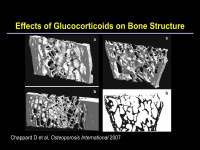 Abbildung 22: Osteoporose