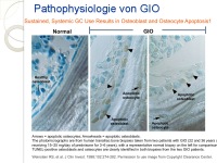 Abbildung 5: Glukokortikoidinduzierte Osteoporose