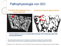 Abbildung 6: Glukokortikoidinduzierte Osteoporose