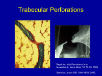 Abbildung 30: Trabekularperforation