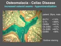 Abbildung 18: Osteomalazia