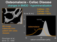 Abbildung 19: Osteomalazia