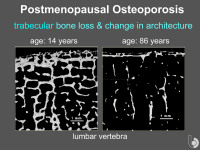 Abbildung 21: Postmenopausale Osteoporose
