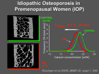 Abbildung 24: Idiopathische Osteoporose