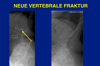 Abbildung 7: Vertebrale Fraktur