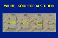 Abbildung 14: Wirbelk�rperfraktur
