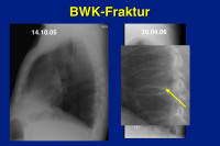 Abbildung 19: BWK-Fraktur