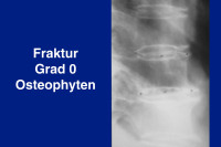 Abbildung 21: Fraktur Grad 0