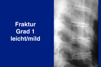 Abbildung 22: Fraktur Grad I