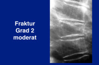 Abbildung 23: Fraktur Grad 2