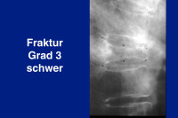 Abbildung 24: Fraktur Grad 3