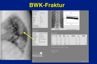 Abbildung 25: BWK-Fraktur