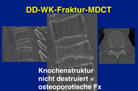 Abbildung 29: DD-WK-Fraktur-MDCT