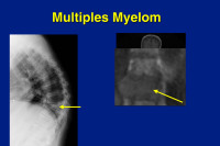 Abbildung 34: Multiples Myelom