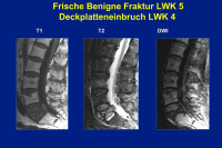 Abbildung 41: Benigne Fraktur