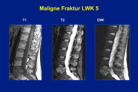 Abbildung 43: Maligne Fraktur - LKW