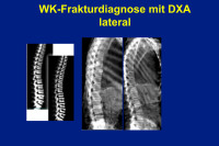 Abbildung 44: WK-Frakturdiagnose - DXA