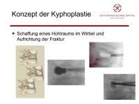 Abbildung 3: Kyphoplastie