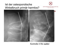 Abbildung 6: Osteoporotischer Wirbelbruch