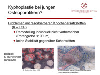 Abbildung 19: Kyphoplastie