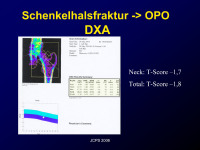 Abbildung 7: Schenkelhalsfraktur - OPO - DXA