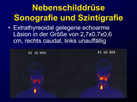 Abbildung 18: Nebenschilddr�se - Sonographie