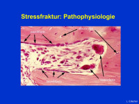 Abbildung 6: Stressfrakturen