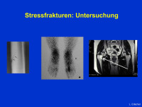 Abbildung 14: Stressfrakturen