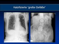 Abbildung 2: Osteoporose - Arteriosklerose