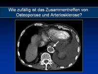 Abbildung 3: Osteoporose - Arteriosklerose