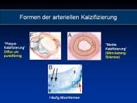 Abbildung 5: Osteoporose - Arteriosklerose