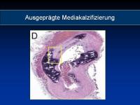 Abbildung 6: Osteoporose - Arteriosklerose