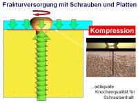 Abbildung 4: Osteosynthese