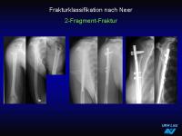 Abbildung 14: Frakturen